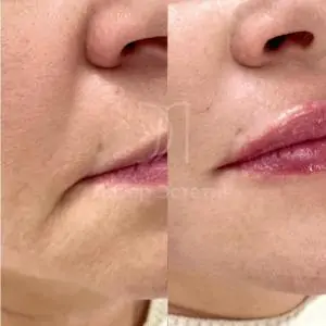 Контурная пластика