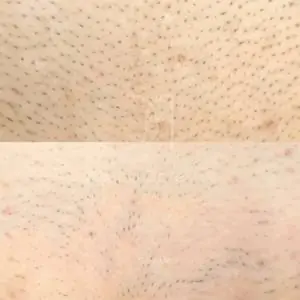 Лазерная эпиляция зоны бикини