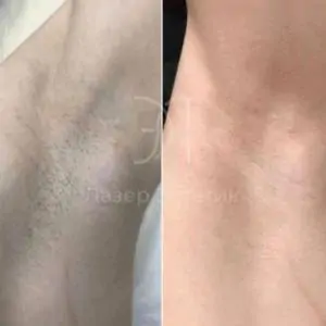 Лазерная эпиляция подмышек