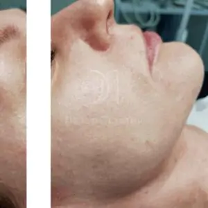 Фракционное омоложение - после